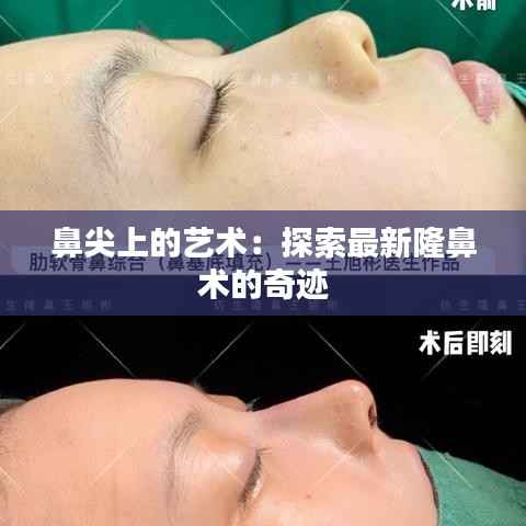 鼻尖上的艺术：探索最新隆鼻术的奇迹