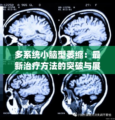 多系统小脑型萎缩:最新治疗方法的突破与展望