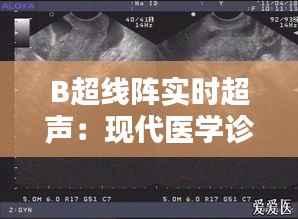 B超线阵实时超声：现代医学诊断的利器