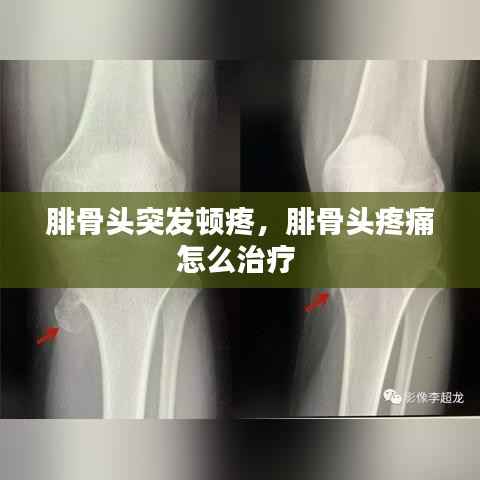 腓骨头突发顿疼,腓骨头疼痛怎么治疗